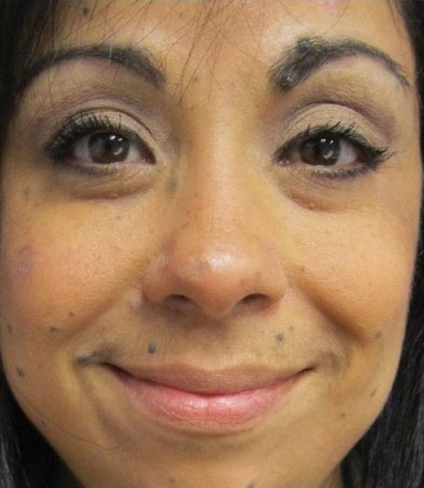 After Image: Laser Resurfacing - front