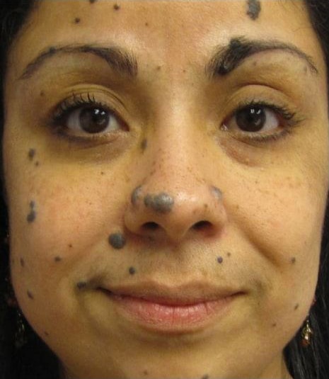 Before Image: Laser Resurfacing - front