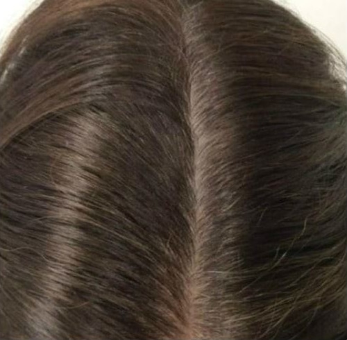 After Image: Hair Restoration - front