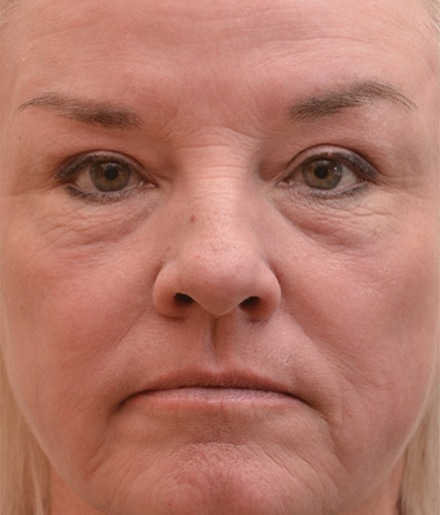 After Image: Laser Resurfacing - front