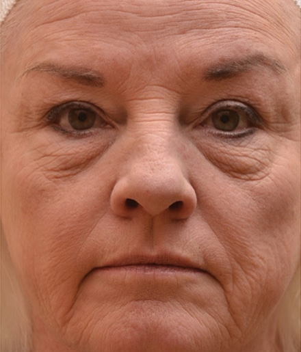 Before Image: Laser Resurfacing - front