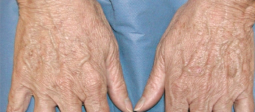 After Image: Laser Treatments - front