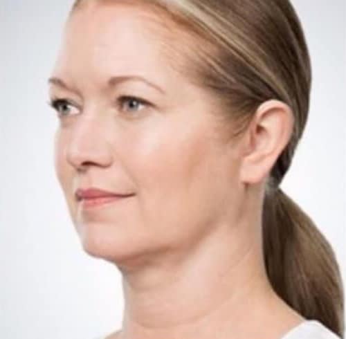 After Image: Kybella - left-front-oblique