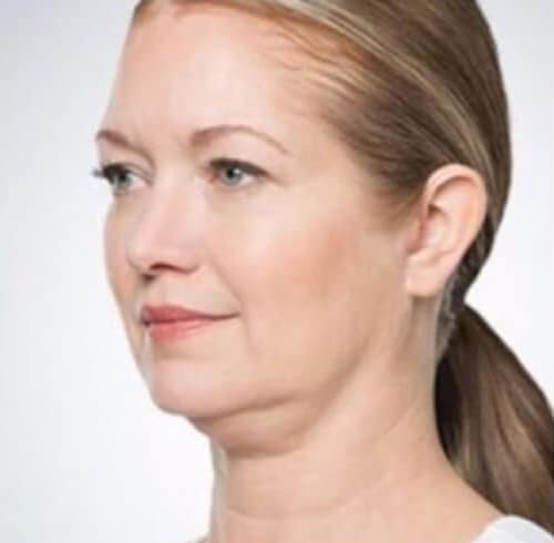 Before Image: Kybella - left-front-oblique