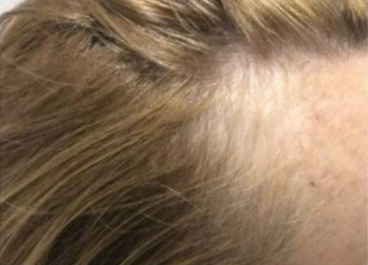 Before Image: Hair Restoration - right-side