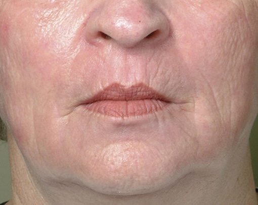 After Image: Laser Resurfacing - front