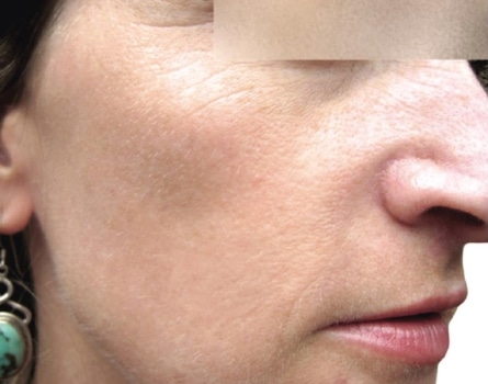 After Image: Laser Treatments - right-front-oblique