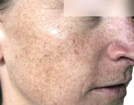 Before Image: Laser Treatments - right-front-oblique