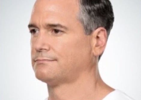 After Image: Kybella - left-front-oblique