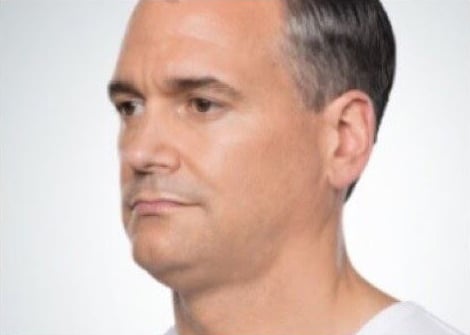 Before Image: Kybella - left-front-oblique