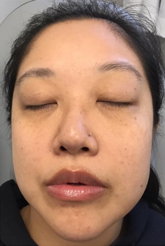 After Image: Laser Treatments - front