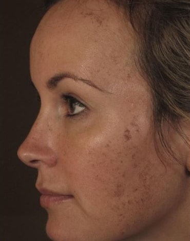Before Image: Laser Treatments - left-side