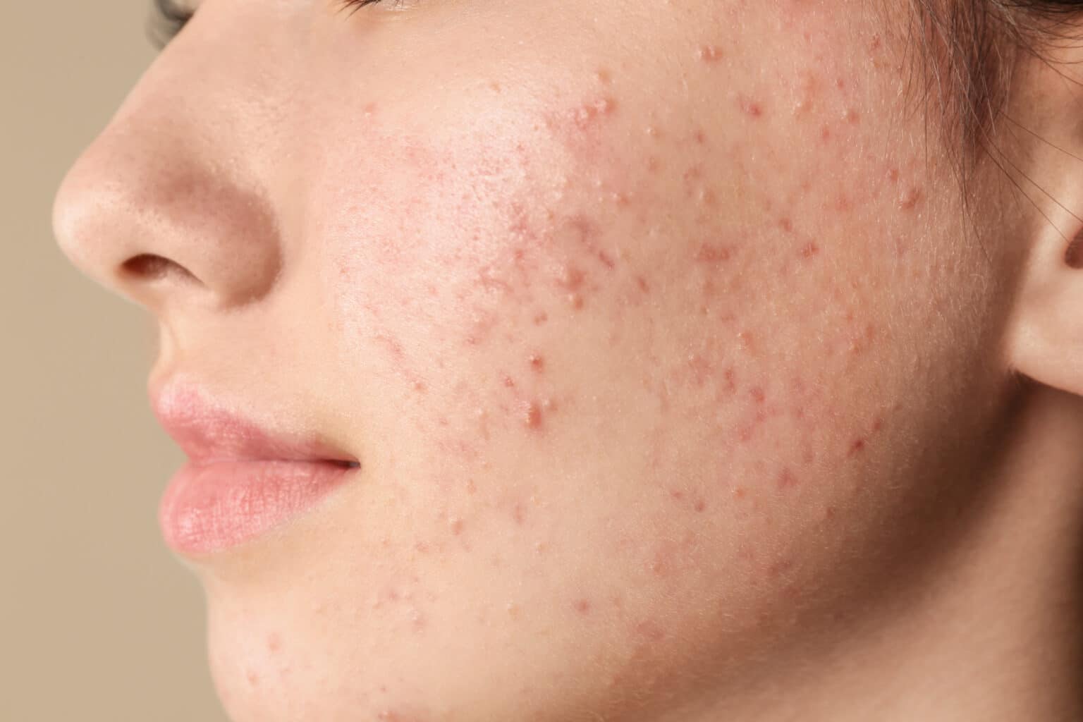 Teenage,Girl,With,Acne,Problem,On,Beige,Background,,Closeup