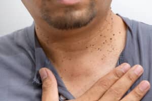 Close up of a tanned man showing the cluster of skin tags on his neck, in need of a skin cancer screening.