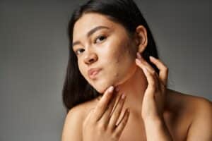 Woman touching her face and showing her hormonal acne from imbalanced estrogen levels