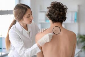Dermatologist checking a patient's mole for skin cancer, specifically melanoma