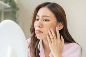Young woman looking upset at the appearance of brown melasma spots appearing on her cheeks after sun exposure